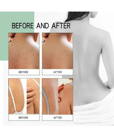 Back Acne Treatment Spray Body Acne Spray Gentle Acne Oil Control Redness Smooth Skin Cleans Pores Moisturizes Easy to Use and Quick Dry Formula For All Skin Type - 3.88 oz(100ML) - Buy Online on GoSupps.com