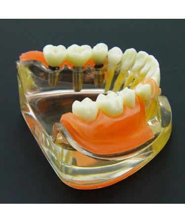 Dental Implant Restoration Model | Removable Bridge & Denture Demo for Teaching & Patient Education - Buy Online on GoSupps.com