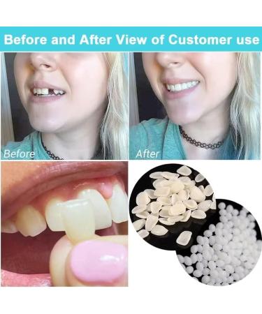 Fake Tooth Repair Kits for Filling The Missing Broken Tooth and Gaps-Moldable Fake Teeth and Thermal Beads Replacement Kits - Buy Online on GoSupps.com