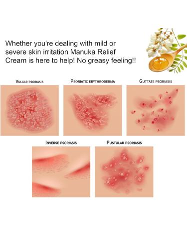 Manuka Honey Draw Salve Cream for Seborrheic Dermatitis Eczema Rosacea & More - Soothing Relief for Irritated Skin | International Shipping - Buy Online on GoSupps.com