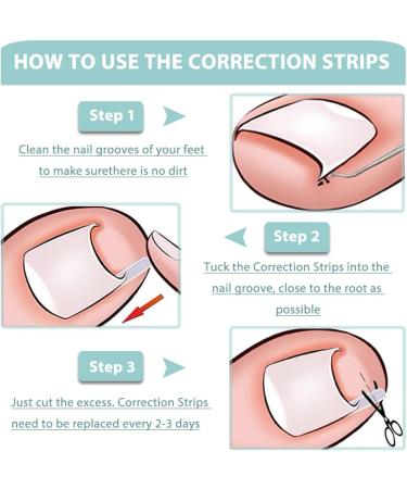 KINDOYO Correction Ingrown Toenails Set - 40 Pieces Painless Toenail Smoothing Strips with Toenail Lifter - Simple Tool Set for Ingrown Toenails - Buy Online on GoSupps.com