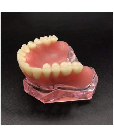 Vinbcorw Dental Model - Maxilla Mini 4 Implant Screws for Mobile Prosthesis Repairs | Removable Pink Design - Buy Online on GoSupps.com