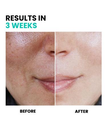 Conatural Anti-Pigmentation Serum 30ml - Dark Spot Corrector for Hyperpigmentation & Dull Skin - Antioxidant Treatment for Effective Dark Spot Removal - Buy Online on GoSupps.com