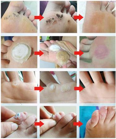 Wart Removal Plasters 24Pcs - Hands & Feet Corn Remover with Hole Plantar Warts Callus - Stops Regrowth - Effective Wart Treatment - Buy Online on GoSupps.com