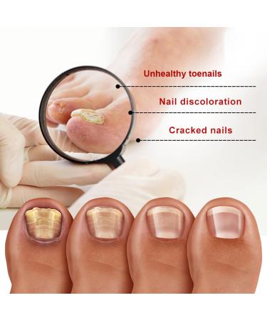 2PCS Kerassentials Toenail Treatment - Extra Strength Formula for Repairing Damaged Nails (30ml) - Buy Online on GoSupps.com