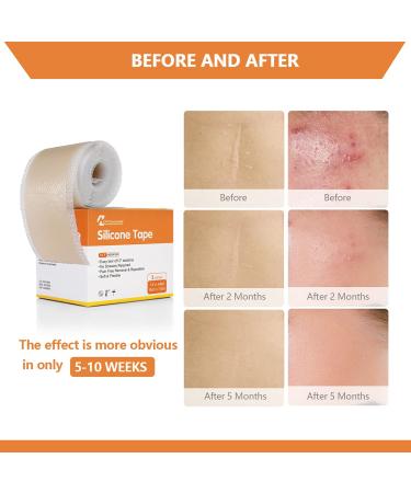 Medical Grade Silicone Scar Tape Roll - Postpartum Belly Band for Scars, Keloids, Burns & Thyroid - 1.6 x 60 | Effective Scars Removal Solution - Buy Online on GoSupps.com