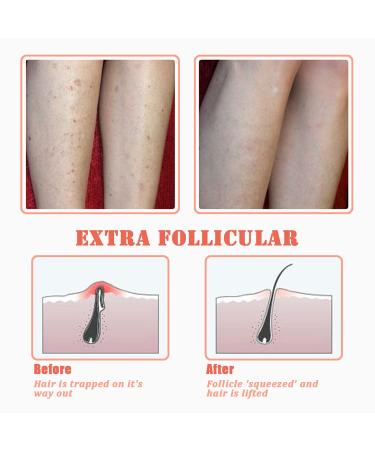 TailaiMei Exfoliating Brush for Ingrown Hair Treatment - Prevent Bikini Bumps and Razor Bumps - Smooth Skin Solution (Orange) - Buy Online on GoSupps.com