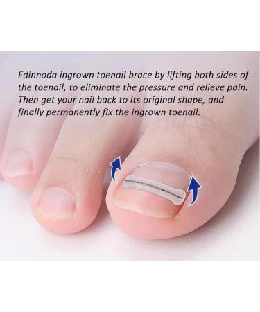 Ingrown Toenail Correction Kit | Pain-Free Home Treatment for Big Toe Nail (Upgraded Brace Patent Pending) - Shop Now - Buy Online on GoSupps.com