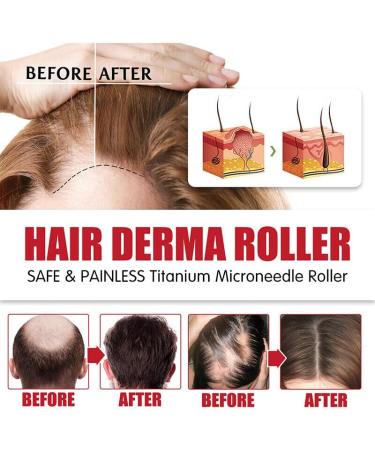 Dermaroller Set de micro-aiguilles professionnelles en titane avec 1 jeu de s rum de croissance des cheveux anti-chute de cheveux 1 jeu d'aiguilles professionnelles en titane de 0 5 mm 30 ml (Lot de 1) - Buy Online on GoSupps.com