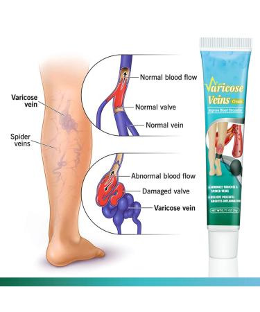 Buy Lichengtai Varicose Veins Cream - 3PCs Spider Vein Treatment for Clearer Legs | Fast International Shipping - Buy Online on GoSupps.com