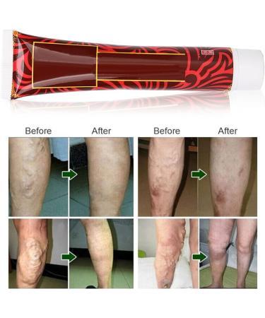 Varicose Vein Treatment Cream for Phlebitis & Angiitis | Blood Vessel Health Care - Buy Online on GoSupps.com