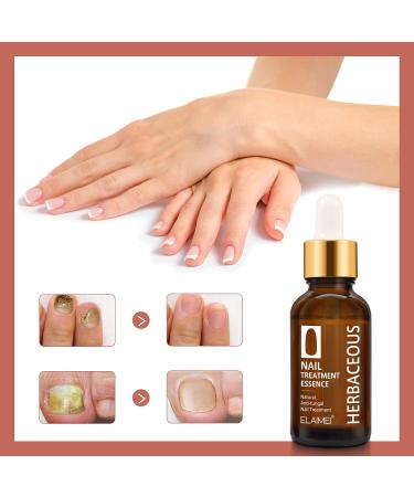 Anti Fungal Nail Treatment | Severe Fungal Nail Treatment | Premium Fungal Nail Destroyerfor Toenails Extra Strong | 30ML (2 Bottle) - Buy Online on GoSupps.com