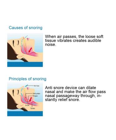 Qkiss Anti-Snore Nose Purifier - Upgraded Stopper Device for Snoring Relief and Air Filtration - Buy Online on GoSupps.com