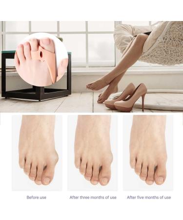 Gel Toe Separators for Bunion Relief with 2 Loops - Overlapping Toe Bunion Corrector & Cracked Heel Cream - One Size - Buy Online on GoSupps.com