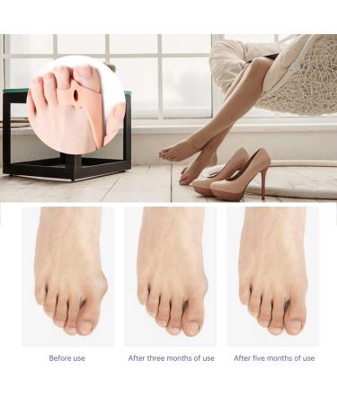 Overlapping Toe Bunion Corrector with Gel Separators - 2 Loop Splint for Big Toe Space, Suitable for Bunions - One Size - Buy Online on GoSupps.com
