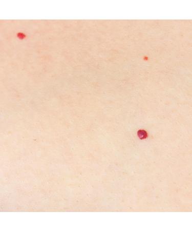Naturasil Cherry Angiomas 10ml | Shop Liquid Roller for Effective Skin Treatment Worldwide - Buy Online on GoSupps.com