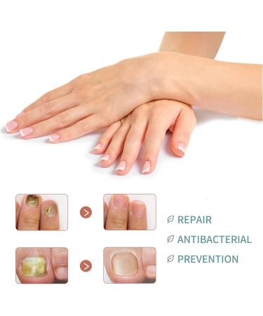 Fungal Nail Treatment | Strengthens Toenails | Toe Nail Fungus Solution - Buy Online on GoSupps.com
