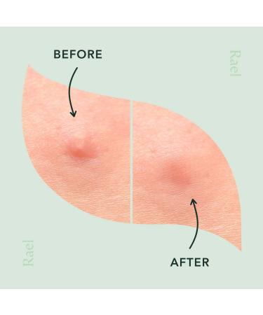 Rael Pimple Patches - Hydrocolloid Acne Spot Cover with Tea Tree Oil (27 Count) - Buy Online on GoSupps.com