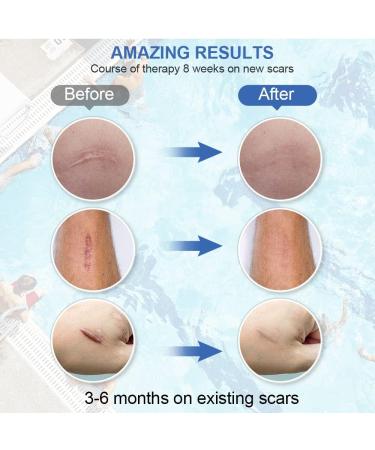 Silicone Scar Strips 1.6 6 - Multi-Use Scar Removal Cream 4 pcs - Reusable Silicone Scar Sheets - Buy Online on GoSupps.com
