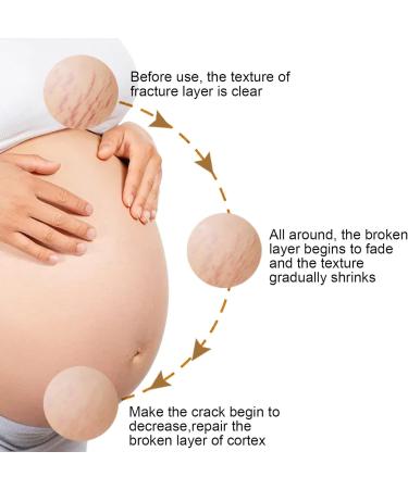 Stretch Mark Cream Prevention Stretch Mark Cream Skin Hydration Whitening Specialized Care for Stretch Marks Dry Skin and Irregular Skin Fragrance Free - Buy Online on GoSupps.com