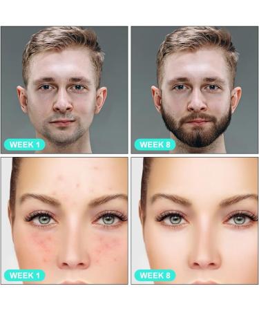 LOPHE Derma Roller 0.5mm Microneedle Derma Roller for Men and Women Professional Microneedling Derma Needling Micro Needle Roller Facial Wrinkles Hair Loss Stretch Marks Hair Regrowth Green head + transparent handle - Buy Online on GoSupps.com