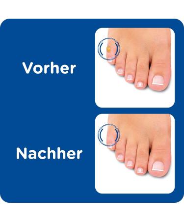 Burgit Corn Plasters MP - Pack of 2 | Effective Foot Care Solution for Corns - International Shipping Available - Buy Online on GoSupps.com