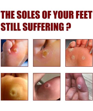 VERAMY Foot Corn Removal Extra Strength Gel - Quick Corn Remover Liquid (3PCS) - Buy Online on GoSupps.com