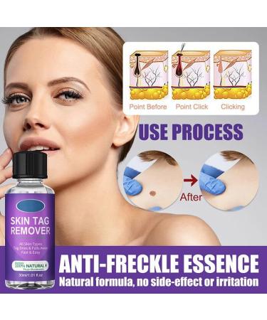 Skin Tag Removal Solution.(2PC 30ML) 2PC 30ml - Buy Online on GoSupps.com