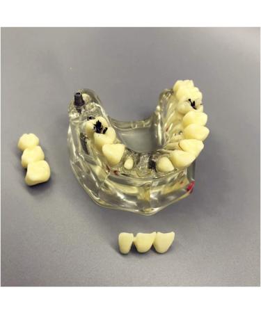 Fhuili Teeth Implant Model - Removable Chewing Gum & Prosthesis - Half-Port Bridge Restoration for Study & Recovery - Buy Online on GoSupps.com