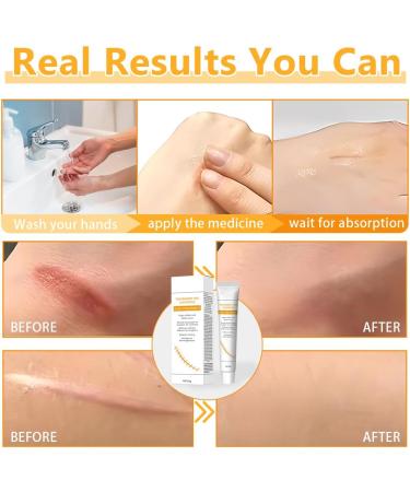 OIXYAZ 1 Piece Scar Cream Gel for Scars Repairing Cream Improve Skin Appearance Daily Use Reduce Skin Imperfections - Buy Online on GoSupps.com
