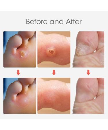 Corn Remover Pads - 24 Pcs Wart & Corn Removal Patches for Feet & Hands - Foot Care Plasters with Holes - Buy Online on GoSupps.com