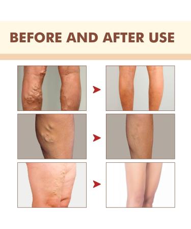 5 Pieces Turmalinstein Moxibustion Patches - Self-Warming Pain Relief Stickers for Men & Women | Plant Extract Massage - Buy Online on GoSupps.com