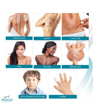 NewGel+E Advanced Silicone Scar Treatment Gel with Vitamin E - For Old and New Scars, Surgery, Injury, Keloids, Burns, and Acne Scars (1 oz) - Buy Online on GoSupps.com