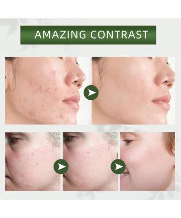 Tea Tree Facial Mask - Deep Cleansing Pore Purifying Clay Mask for All Skin Types Blackheads & Acne Treatment - Buy Online on GoSupps.com