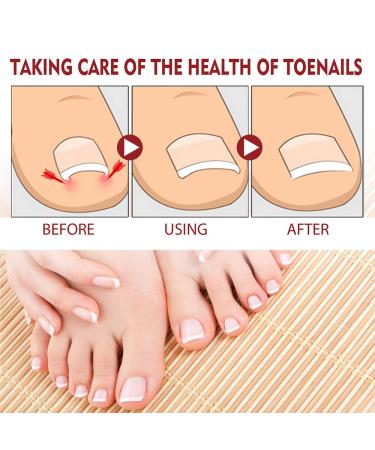 Buy German Toenailplus Anti Paronychia Relief Oil - Ingrown Toenail Treatment Drops (Pack of 3) | Fast International Shipping - Buy Online on GoSupps.com