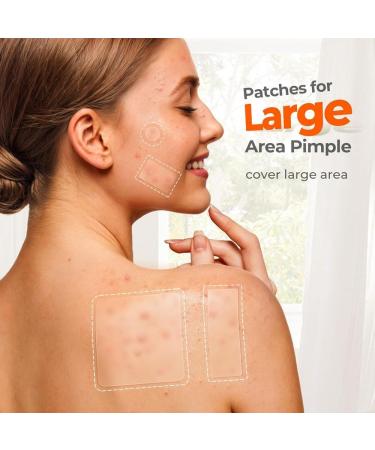 XFSRG 302 large patches of pimples with tea tree oil of salicylic acid and niacinamide for large pimples on chin cheeks back Transparent1 - Buy Online on GoSupps.com