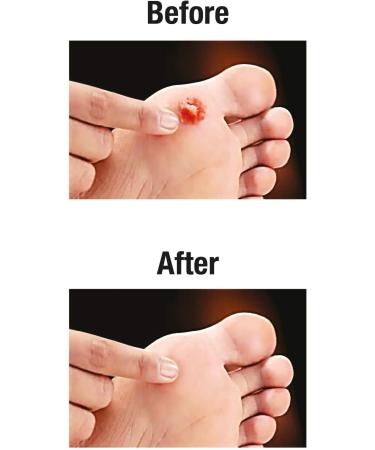 Buy Amrutanjan Decorn Corn Caps - Pack of 10 | Fast International Shipping - Buy Online on GoSupps.com