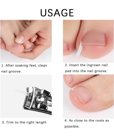 (12 +3) Ingrown Toenail Correction Treatment Kit Ingrown Toenail Correction Strips Brace Kit Ingrown Toenail File and Lifter Ingrown Toenail Corrector Straightener Strips for Nail Foot Care - Buy Online on GoSupps.com