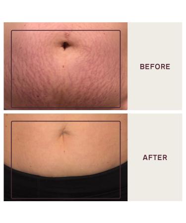 Dermaclara Silicone Stretch Marks Patch Kit | Scar Treatment Gel | Pregnancy Safe Skincare | Postpartum Care | Skin Firming Formula | Baby Shower Gift | Natural Stretch Mark Oil | 2x 7in Patches + Patch Prep - Buy Online on GoSupps.com