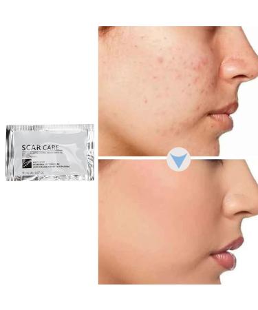Scar Removal Cream | Smoothing Skin & Reduce Formation of Connective Tissue | Repair Cream for Burn & Old Scars | Easy to Use - Buy Online on GoSupps.com
