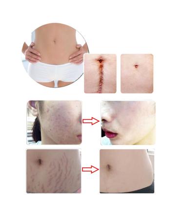 Hotiary Scar Removal Serum - Lavender Repair Essence 30g (1 Pack) - Skin Repair for Cuts, Stretch Marks, Burns & Postoperative Scars - Buy Online on GoSupps.com