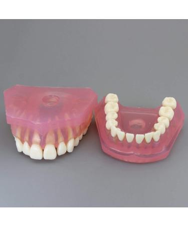 Samnuerly 28 Removable Teeth Dental Implant Model - Translucent Standard for Research & Teaching - Ideal for Removable Lower Jaw - Buy Online on GoSupps.com