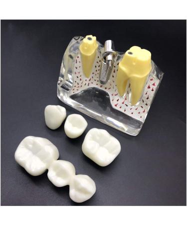Teeth lesson model - 4 times enlarged teeth planting explanation model - simulation oral dental teeth demonstration model - implant nail nail removable crown - for lesson lessons a