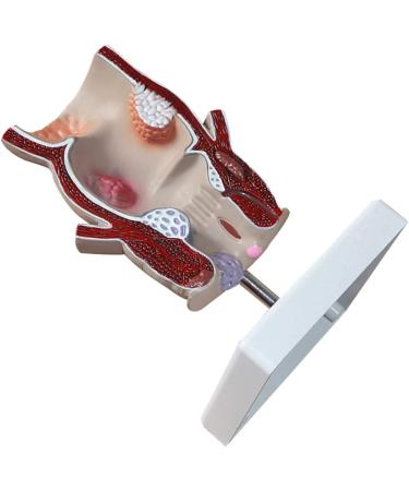 Medical Science Rectum Fissure Lesion Model 5X Human Pathology Model Hemorrhoid Anal Fistula Medical Organ Model - Buy Online on GoSupps.com