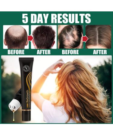 Hocossy Regrowth Organic Hair Serum Roller Set - Scalp Roll-on for Men & Women | Natural Hair Thicker Treatment 20ml - Buy Online on GoSupps.com