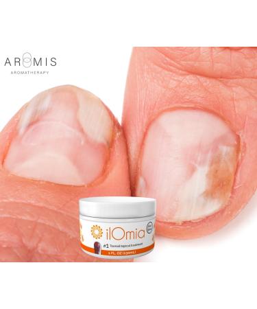 Natural Toenail Fungi Cream - Repair Damaged & Discolored Nails | 1oz USA-Made Solution - Buy Online on GoSupps.com