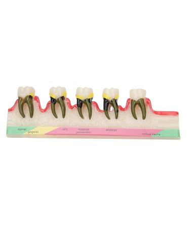 Dental Periodontal Disease Model Tooth Disease Study Teaching Model for Dental School