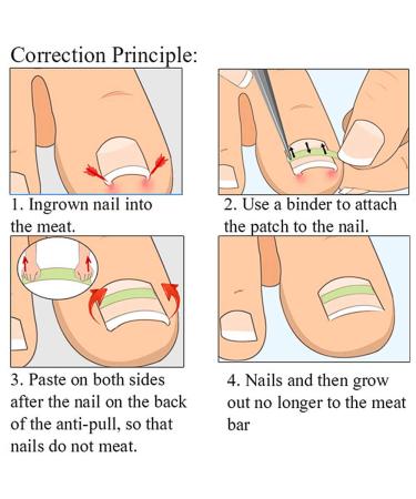 100stk Toenail Correction Stickers for Ingrown Toenails | Foot Care & Pedicure Solution - Buy Online on GoSupps.com