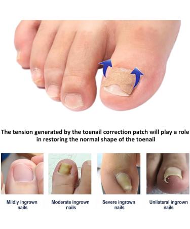 Toenail Patch Ingrown Toenail Toenail Correction Toenail Correction Patch Toenail Correction Patch Ingrown Toenail Nail Care 50 Pieces - Buy Online on GoSupps.com