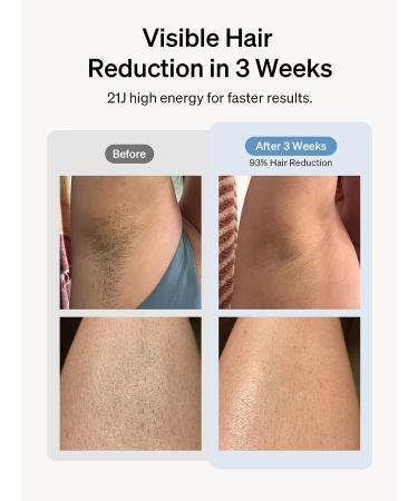 Ulike Laser Hair Removal Air 3 IPL with Sapphire Ice-Cooling System - Painless & Long-Lasting Results for Men and Women - Body & Face Hair Removal at Home - Buy Online on GoSupps.com